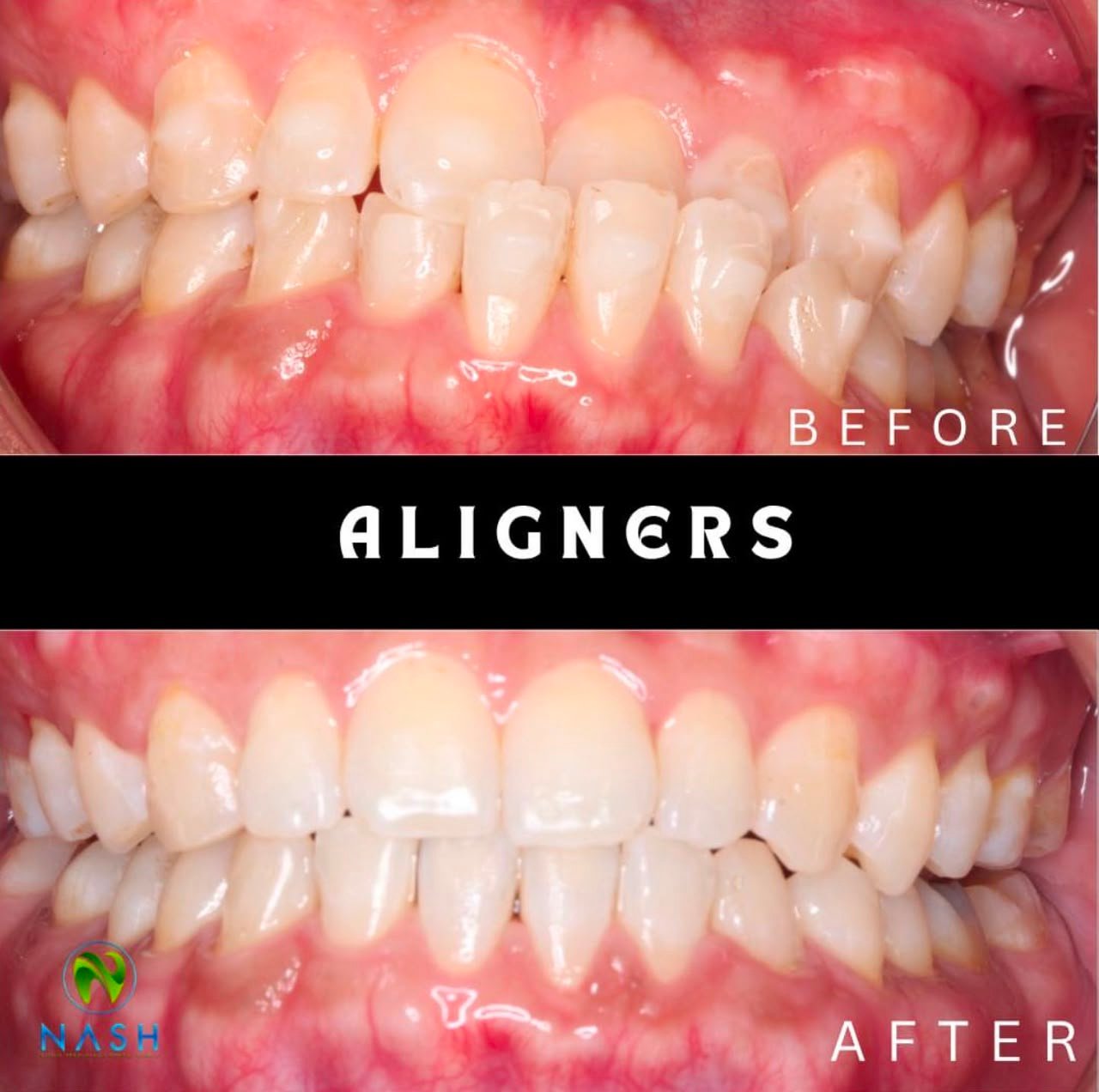 Before after aligners 2