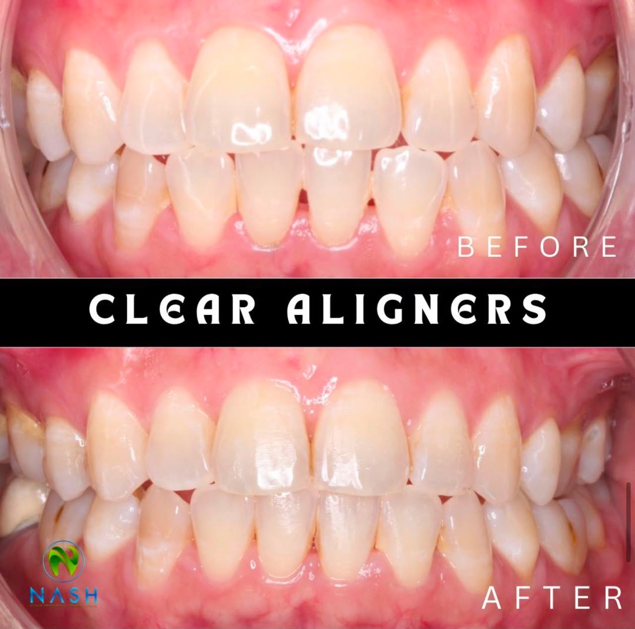 Before after aligners 1