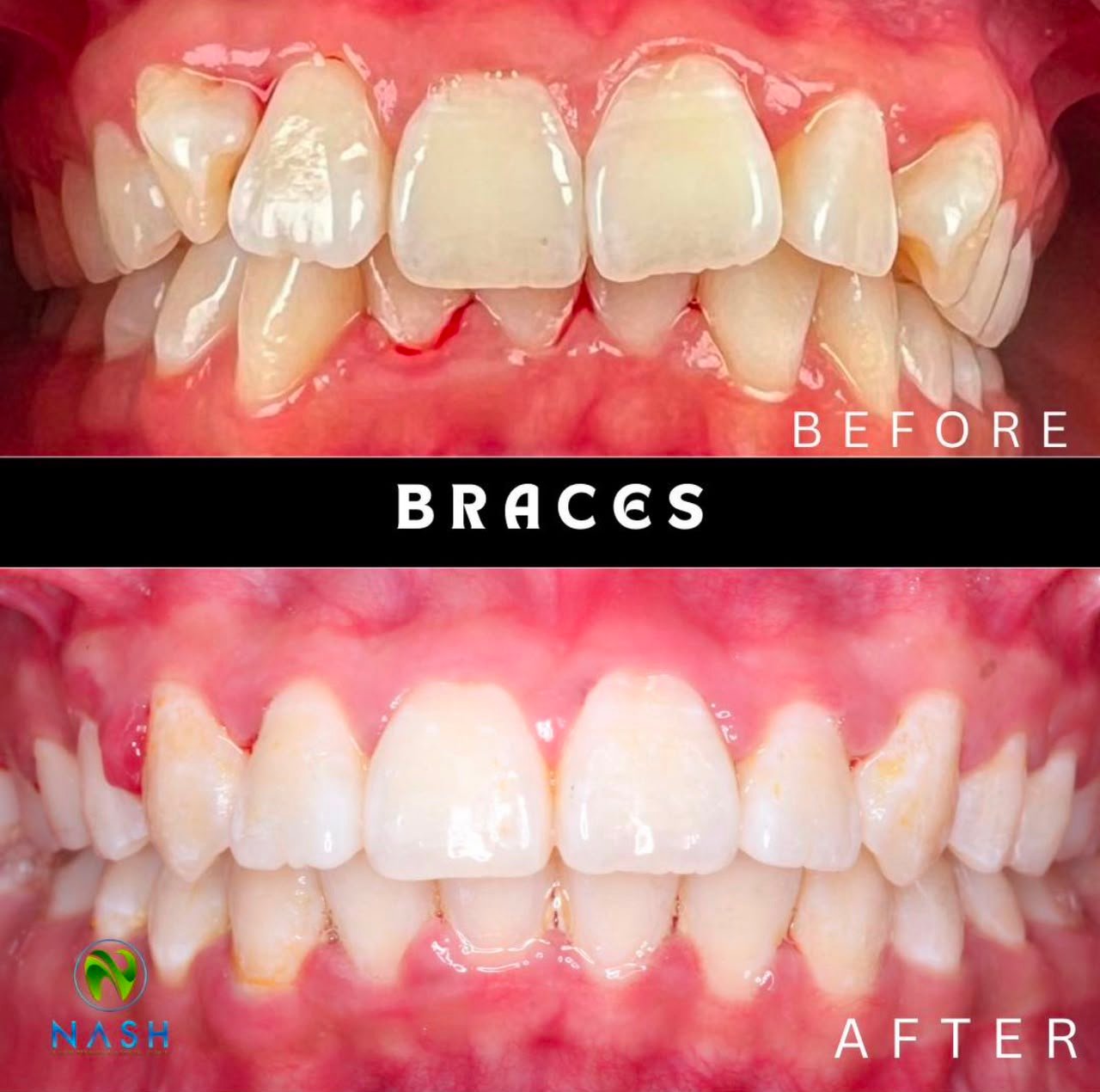Before after braces 1