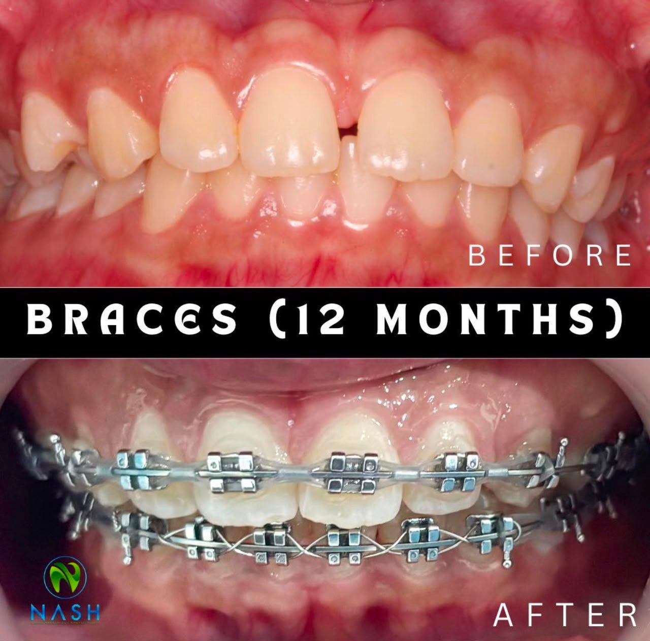 Before after braces NASH Dental